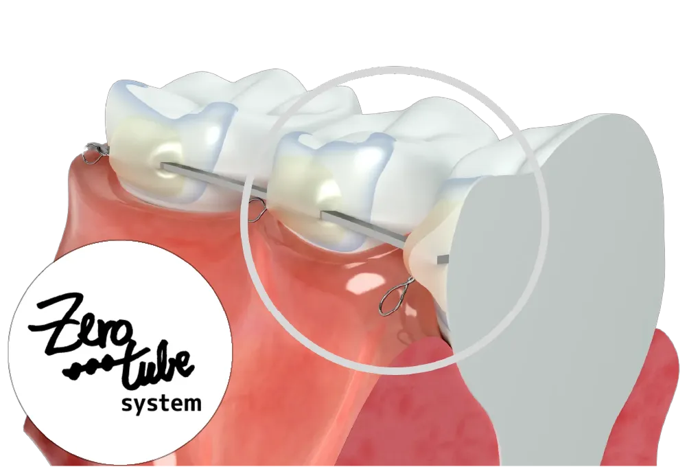 ZERO bracket System